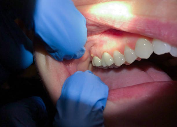 Best Dental Abscess Treatment in Westlake Corner, VA